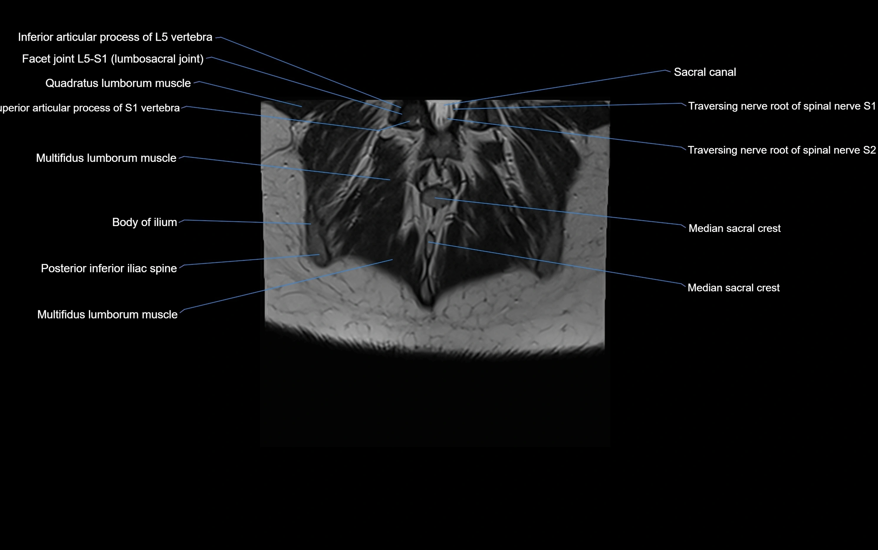 MRI sacroiliac joint coronal cross sectional anatomy  radiology  image-img-00001-00029.webp